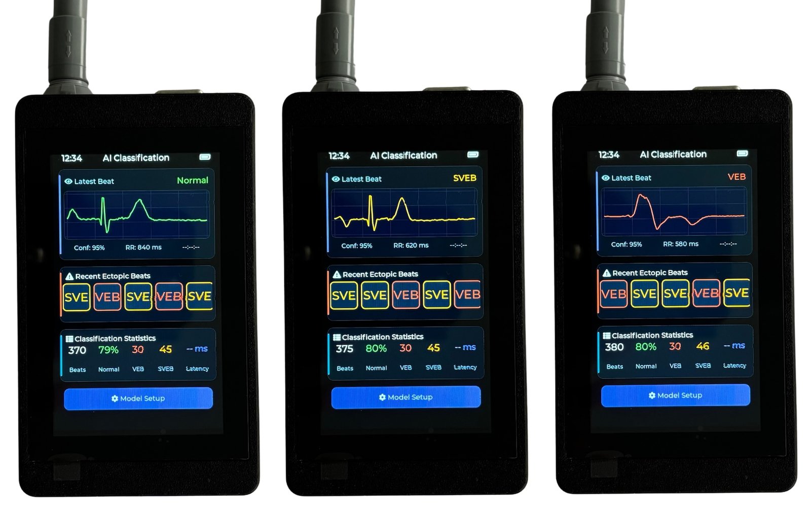 AI Screen with Beat Classification