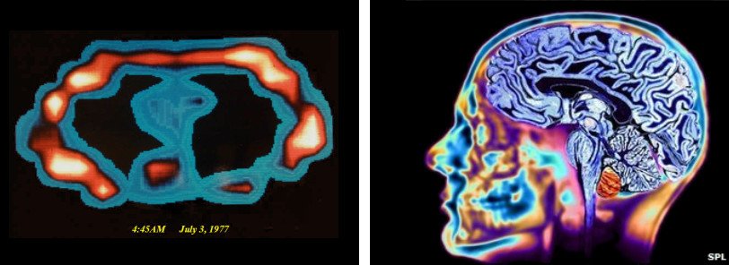 Left: First MRI scan (lungs). Right:  A modern MRI scan (head).